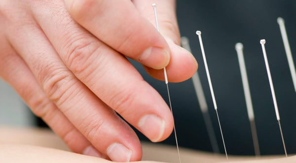 Can Acupuncture Help Endometriosis? Here’s What You Need to Know