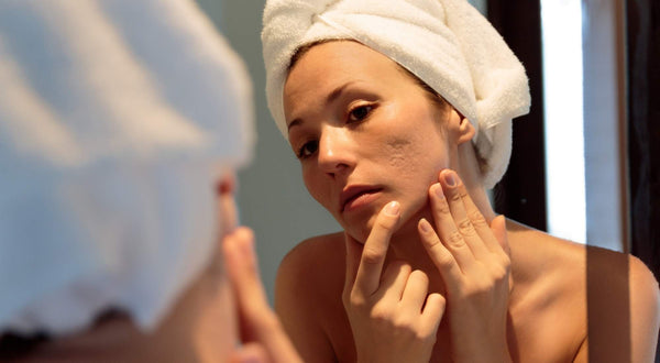 Is Endometriosis the Cause of Your Acne?
